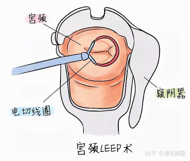 我在美国治疗hpv-cin3的经历(二)leep刀手术