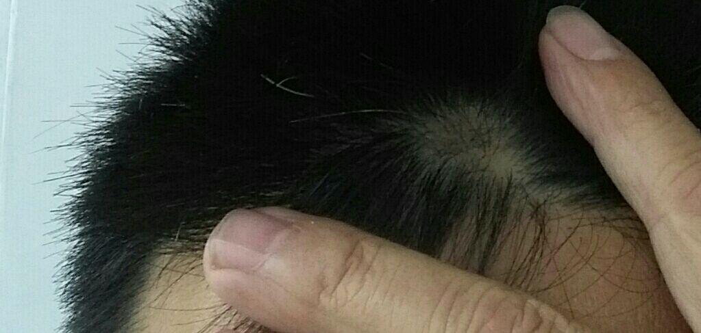 一个斑秃在视频女生,v斑秃?-掉头发-知乎屁女生前额打狠屁图片