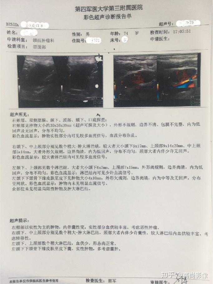 腭部,上颌骨旁占位,考虑恶性肿瘤伴右侧下颌区,颈部淋巴结转移