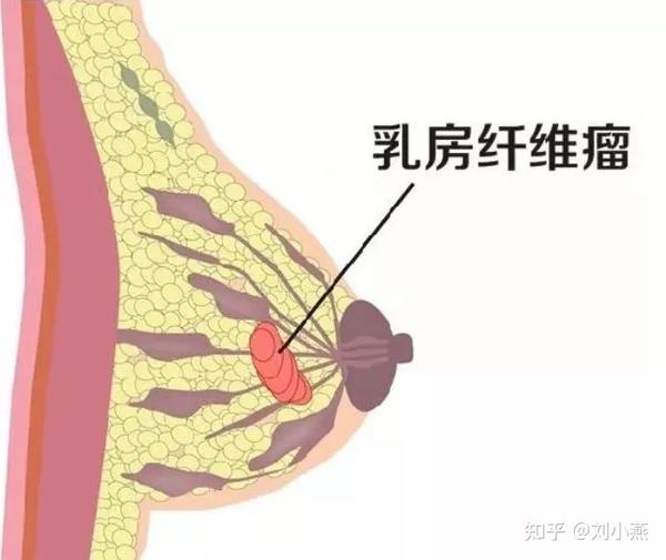 刘燕酿制:常见的几大乳房疾病,你知道多少?