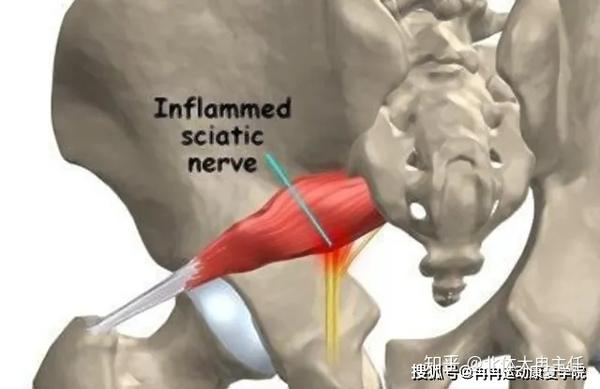 2,髂骨旋前对于梨状肌的肌张力为什么会增加?