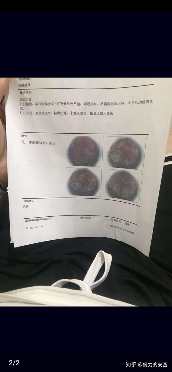 特别注意饮食导致检查不清不楚但是医生给的诊断还是很准说怀疑是内痔