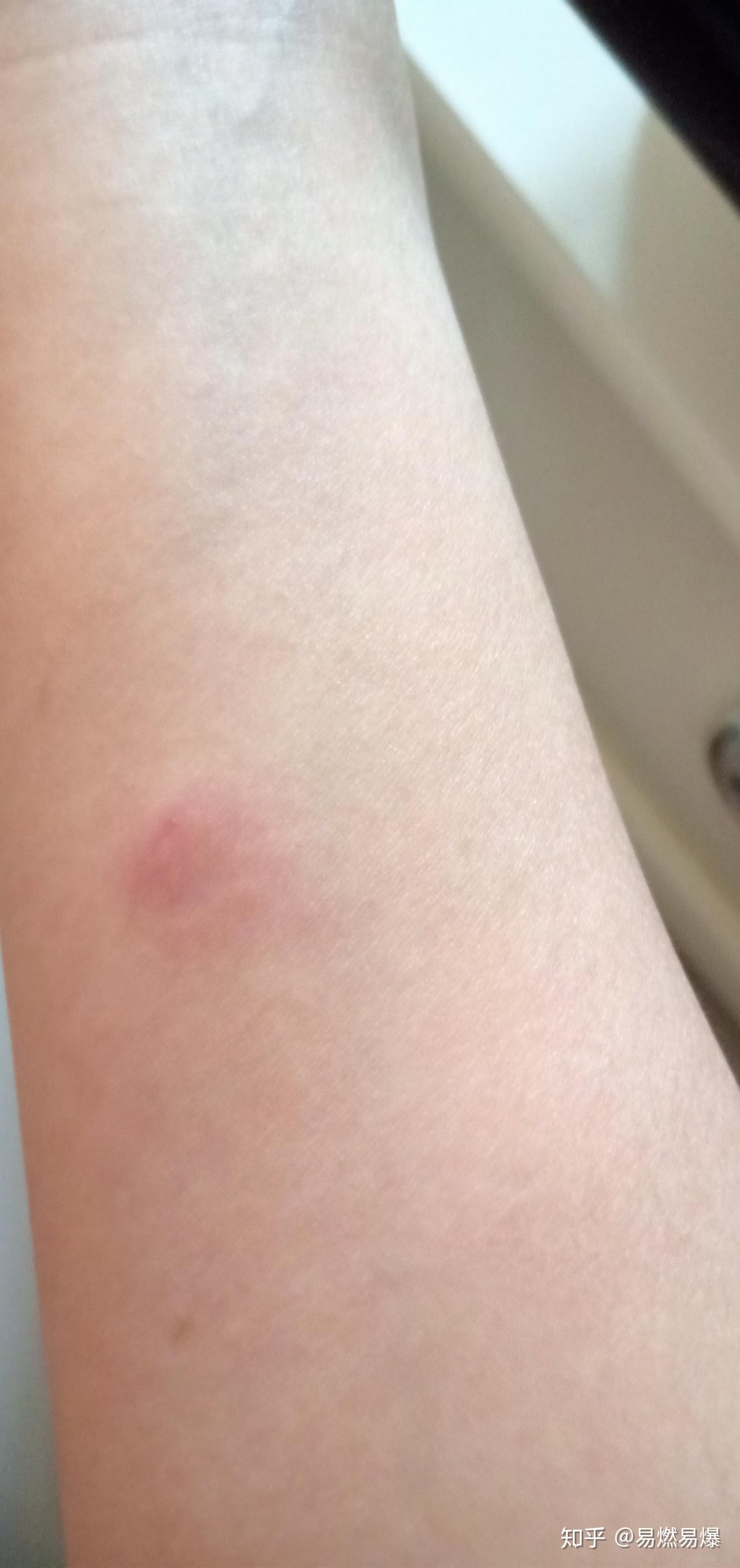 结核皮试出现如下状况是啥结果呢