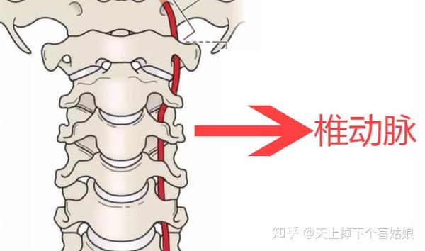 根据小姑娘描述和患者表现,我怀疑是一个 椎动脉型颈椎病.