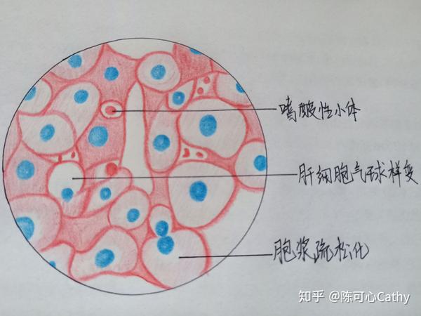 发完就清相册啦~ 有不妥的地方还希望大家指正  一,肝细胞水肿 最后