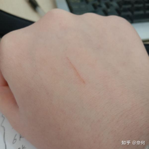 这是被猫挠的伤口,跟它玩的时候,它的爪子抱着我的手,想要咬我,我一躲