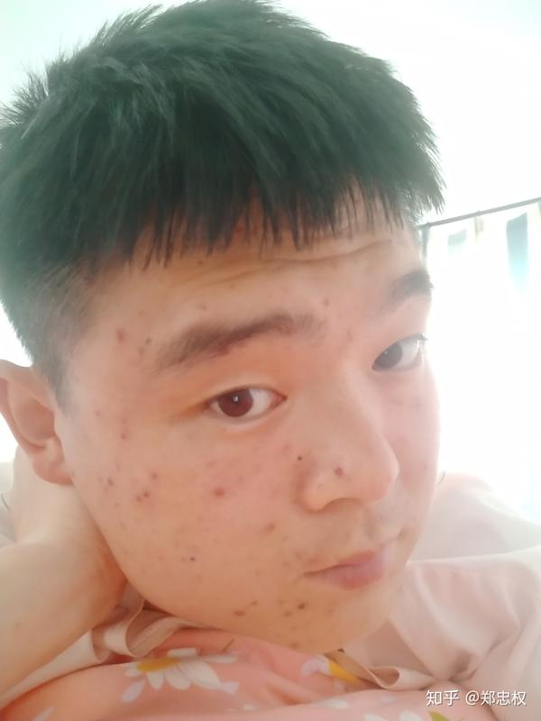 长水痘是一种怎么样的体验?
