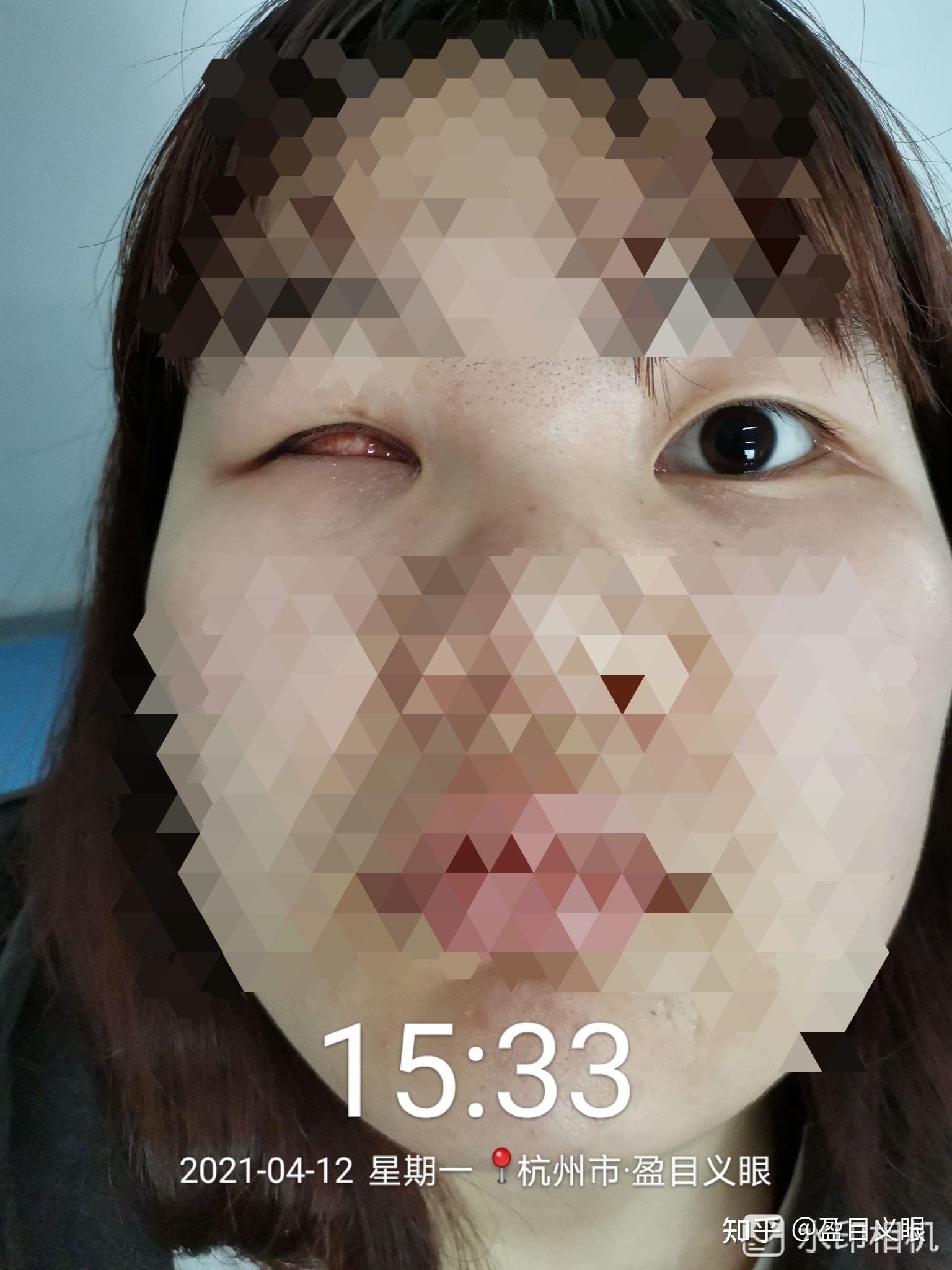 盈目义眼