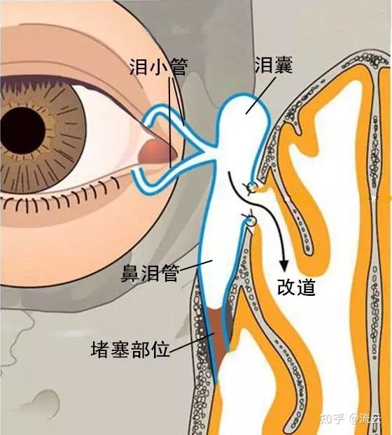 如果诊断为慢性泪囊炎,被流泪不止困扰的你,可以考虑选择手术哦.