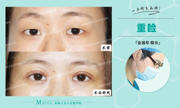 眼皮松弛下垂