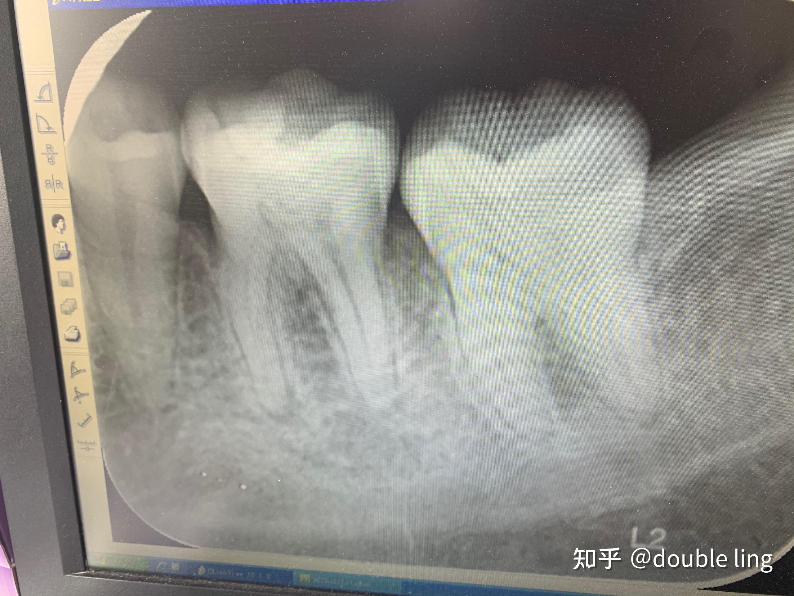 牙髓炎晚上痛得睡不着有没快速入睡的办法?明天就去看