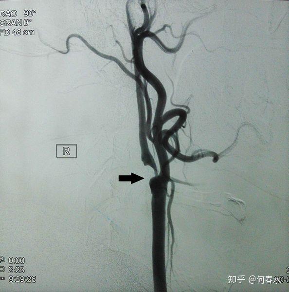 颈动脉内膜剥脱术治疗严重颈动脉狭窄