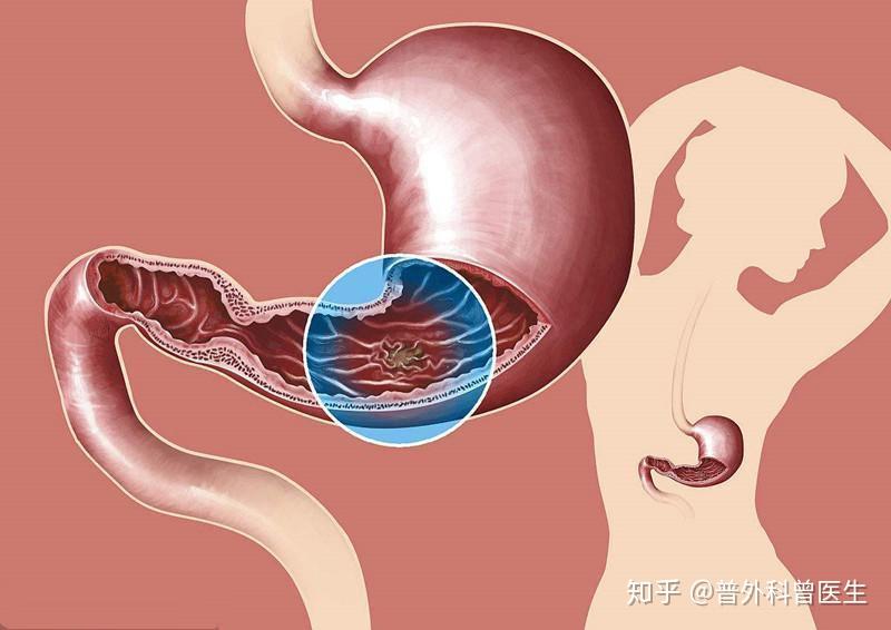 胃溃疡的患者常常是由幽门螺杆菌导致的,也可能合并有胃酸分泌过多