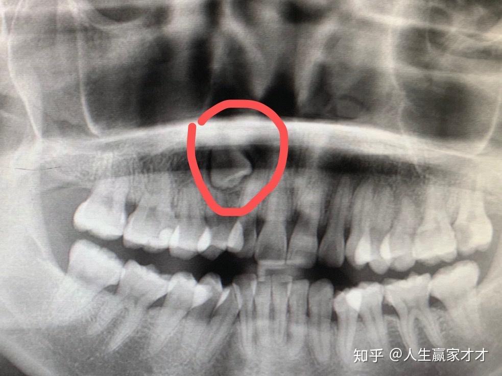 杭州浙二住院全麻拔埋伏牙