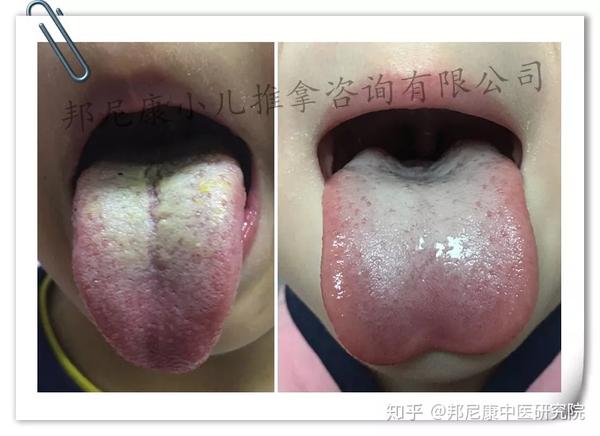 积食舌与腻苔舌