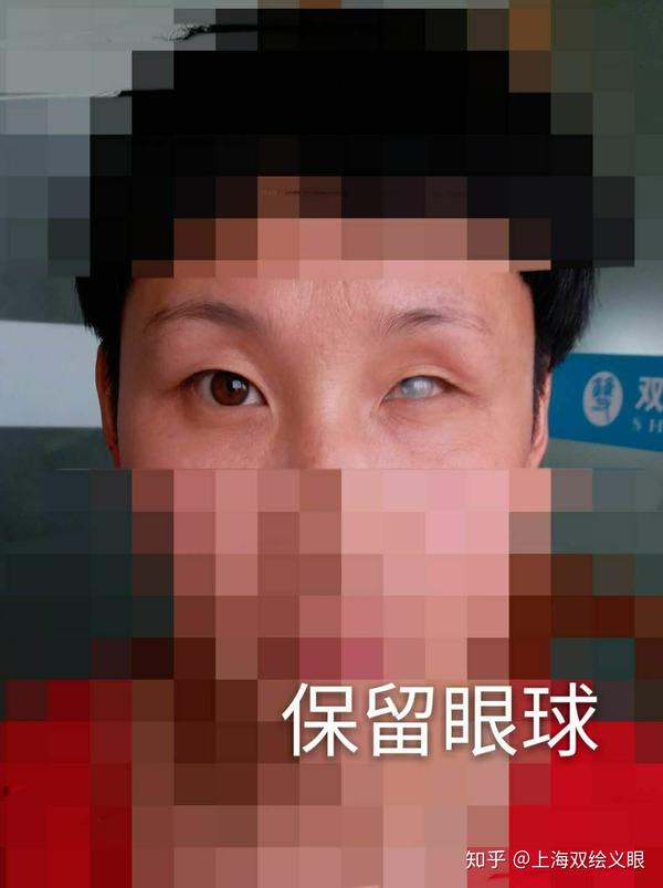 男,刚装了义眼不适应,做什么可以分散注意力?急!在线等?