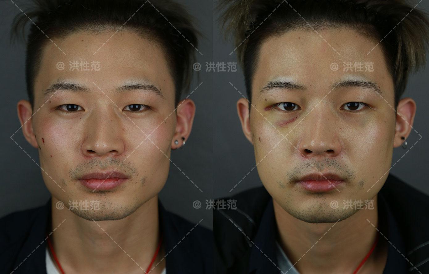 洪颜学院"毕业流程"——下颌角手术术后注意事项(一)