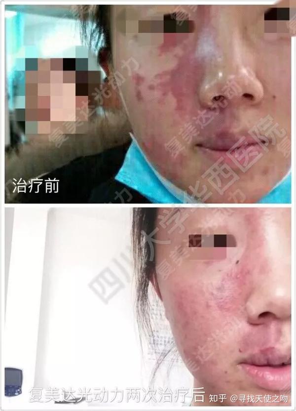 复美达光动力治疗紫红型鲜红斑痣,2次治疗后,大部分颜色消退