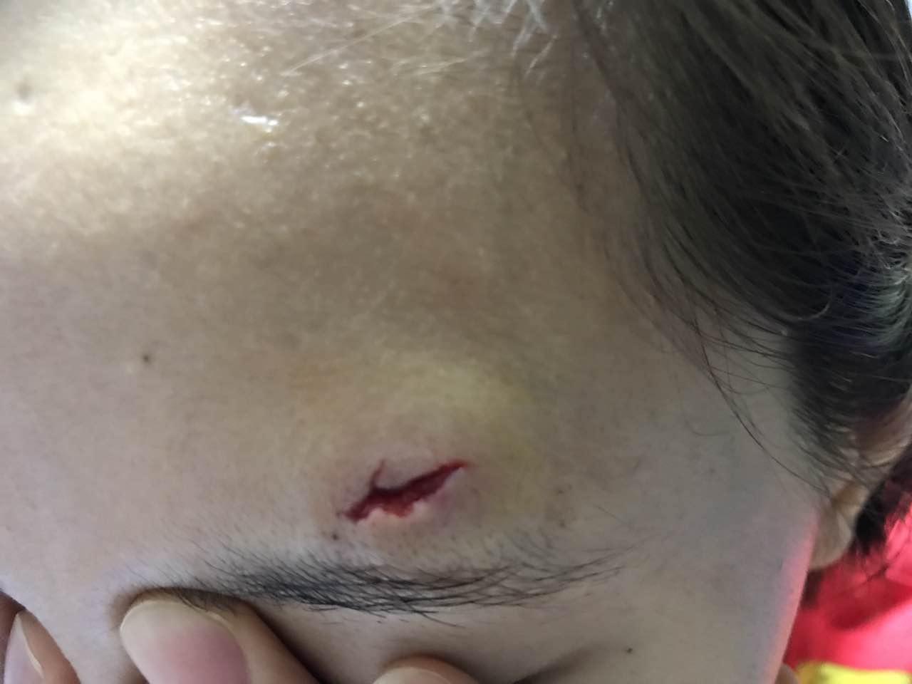 朋友的额头被牙齿磕伤,已经缝了针,有什么办法可以淡化疤痕吗.