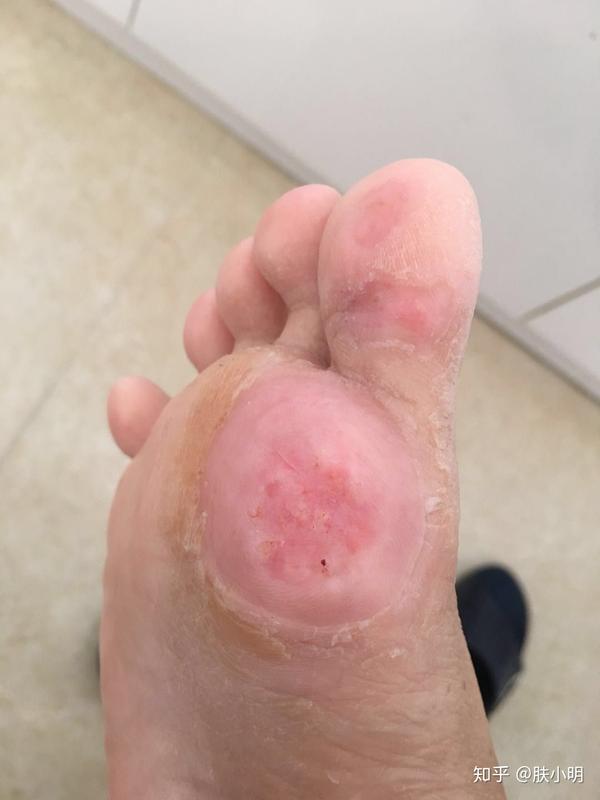 跖疣冷冻知识的全面讲解