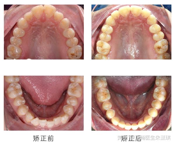 天津牙齿矫正:上下颌扩弓 片切恢复正常覆合覆盖关系