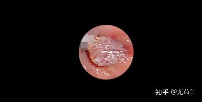 尖锐湿疣初期时患者不会出现痛痒感,呈淡红色的细小皮疹或粟状大小的