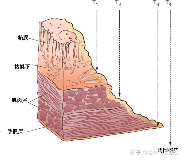 结肠高级别病变是什么?是癌症吗?会不会恶变?应该怎么治疗