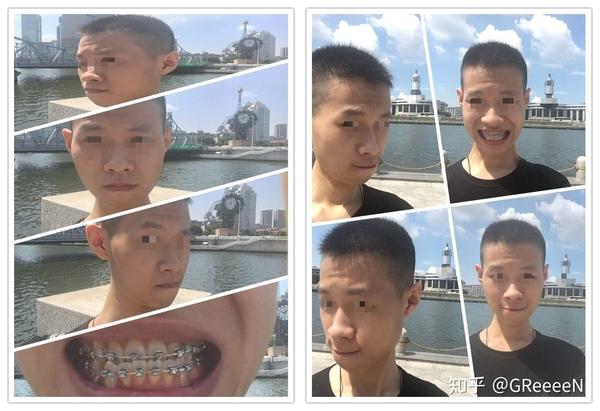 地包天·牙套·矫正·日记18年"正颌·术前·正畸"详细过程费用.