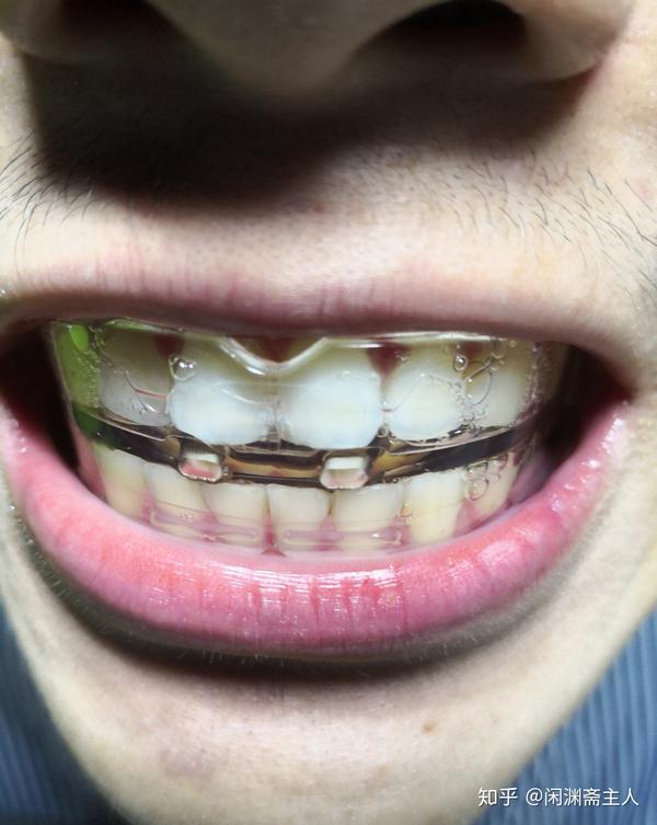 有龋齿的青少年可以戴牙套吗