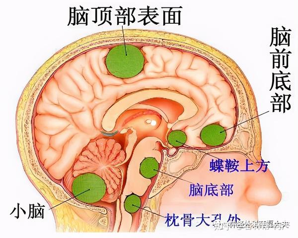 根据其发生的解剖部位分为:凸面脑膜瘤,颅底脑膜瘤和