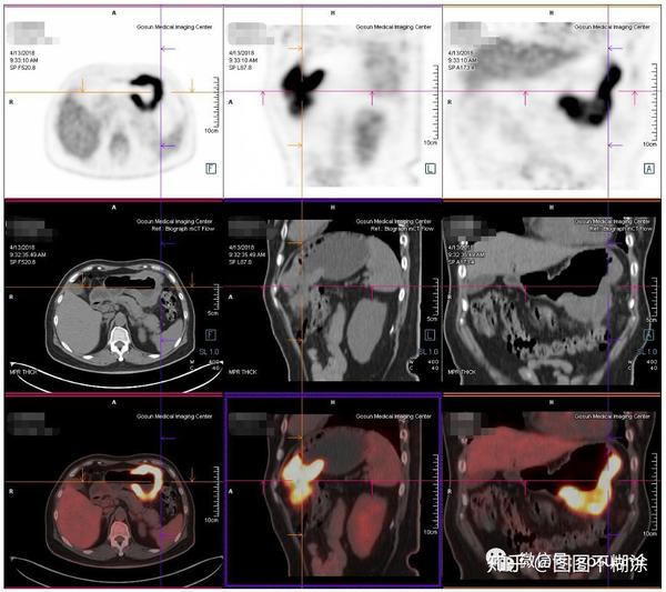 【pet/ct专辑】筛查肿瘤的神器——pet/ct