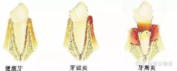 牙龈炎,牙周炎,牙髓炎,傻傻分不清?