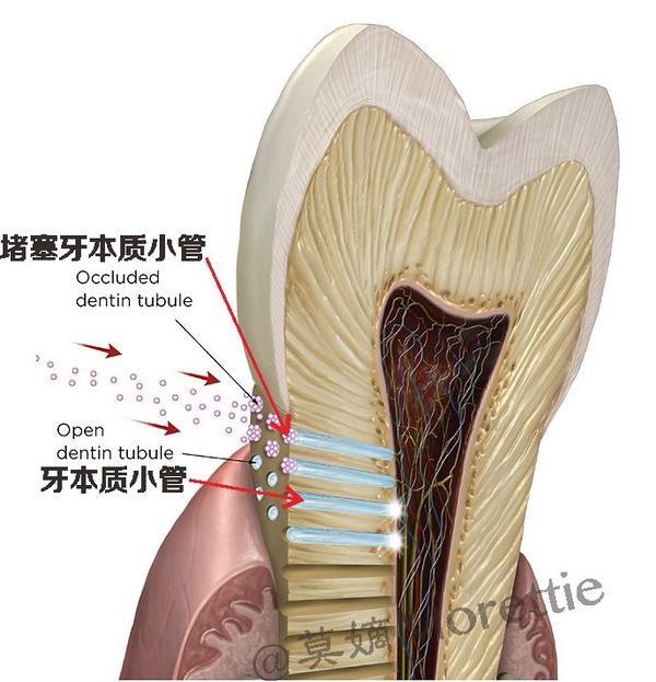 发生反应,以形成矿化层,从而覆盖了暴露的牙本质小管来减轻牙齿敏感