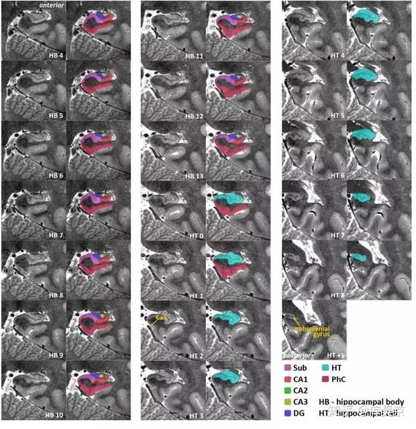 神经影像 | 7t核磁共振分割内侧颞叶解剖结构