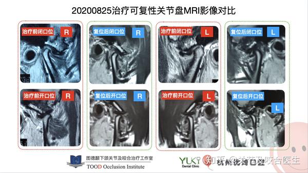 颞下颌可复性关节盘脱位(移位)早期复位可以避免不可复吗?