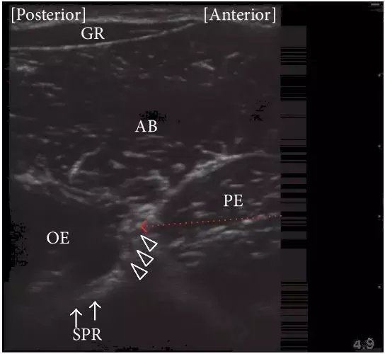 华声临床超声可视化讲座手把手教你超声引导下闭孔神经阻滞的四种入路