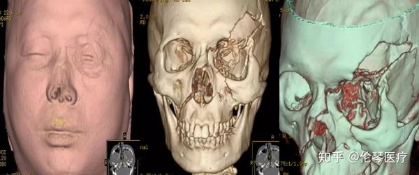 突发外伤以后,患者就医通过ct检查,可以显示患者脑出血,脑挫裂伤,颅骨