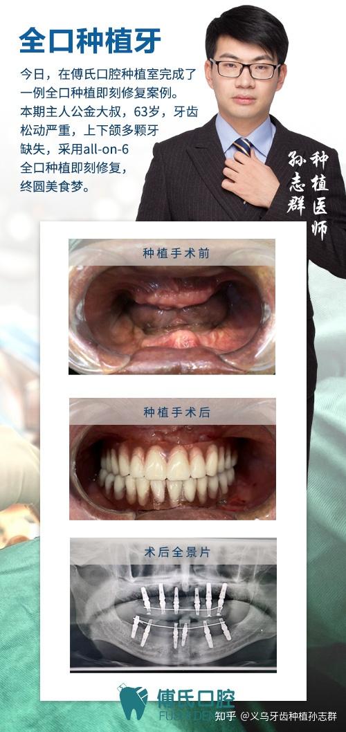 义乌牙齿种植孙志群医师 发布于 06-14