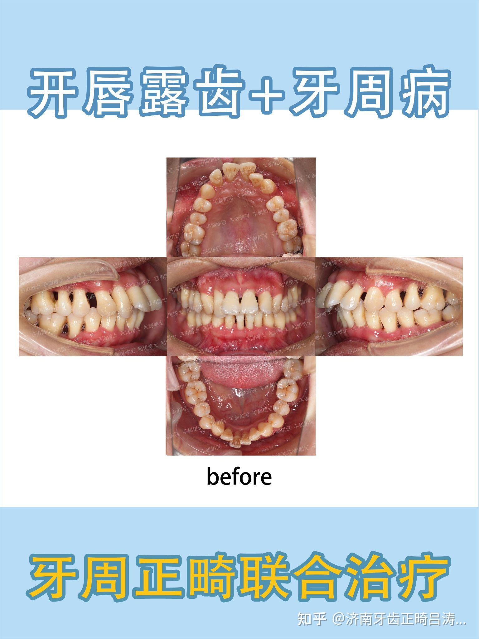 济南牙齿矫正丨济南整牙丨开唇露齿 牙周病丨牙周正畸联合治疗案例