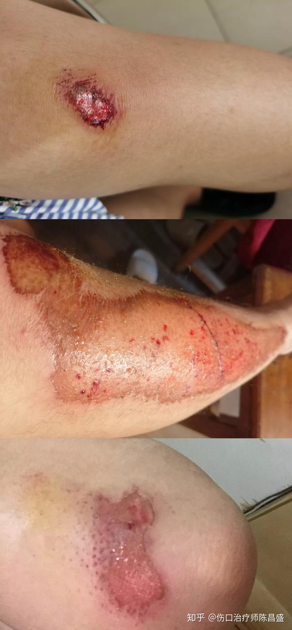 伤口管理第二篇擦伤三板斧让你少走弯路少花钱