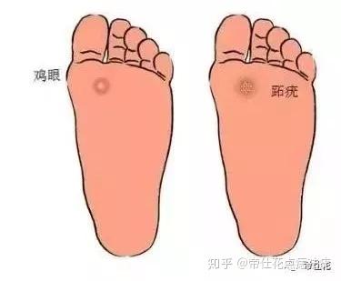 鸡眼和跖疣的区别