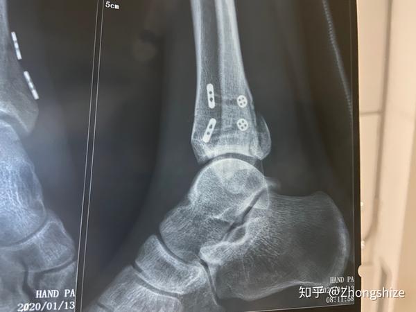 脚踝骨折 三角韧带修复 胫腓联合修复 腓骨上段骨折