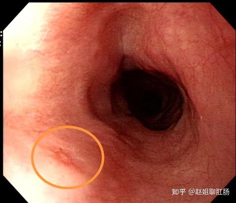 5cm稍发红黏膜,怀疑食道早癌病变,在我院内镜中心专家的