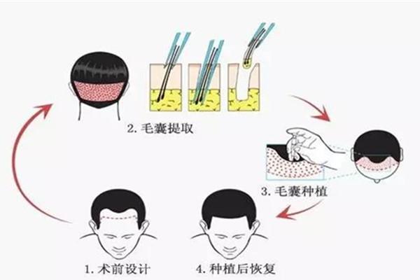 动画演示|解析植发手术全过程