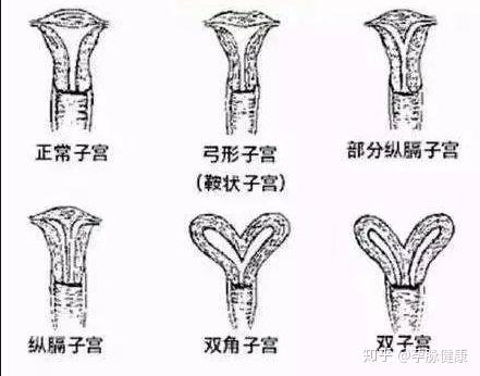 都是只有一套宫颈和阴道,不过具体的发育形态各有所异. 4,纵隔子宫.