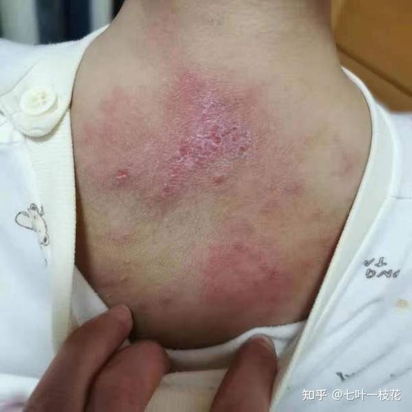 皮损外用氧化锌乳膏,地奈德乳膏后