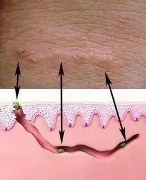疥疮结节里面还有疥虫吗