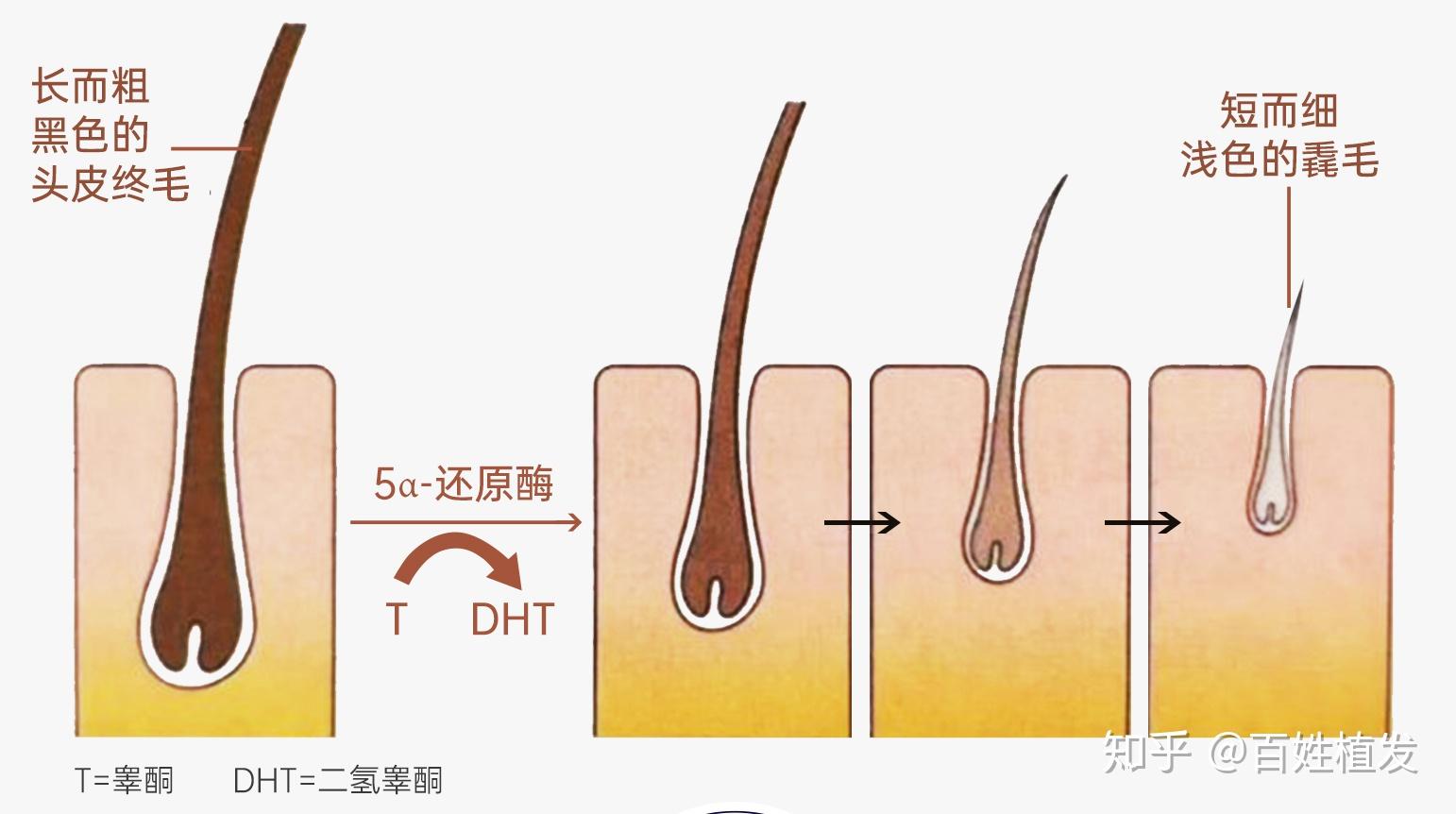 关于脂溢性脱发这三大误区千万别踩