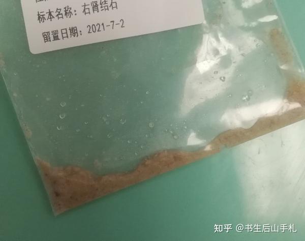 石头送过去检测,3-5天后出结果,我的检测是常见的一水草酸钙结石和二