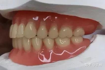 正常咬合:上排牙齿在前,上排牙齿盖住下排牙齿大概三分之一.